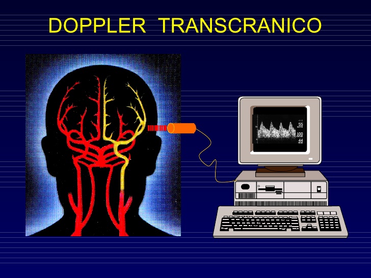 Il doppler transcranico: cos'è e a cosa serve.