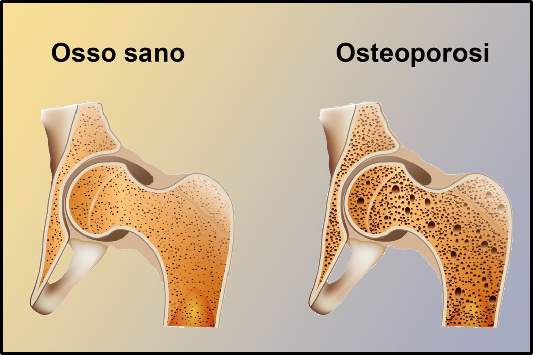 Prevenzione e Trattamento dell'OSTEOPOROSI presso HTC.