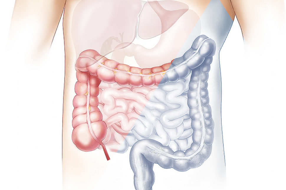 Intestino irritabile: l'importanza di un'alimentazione corretta e delle emozioni