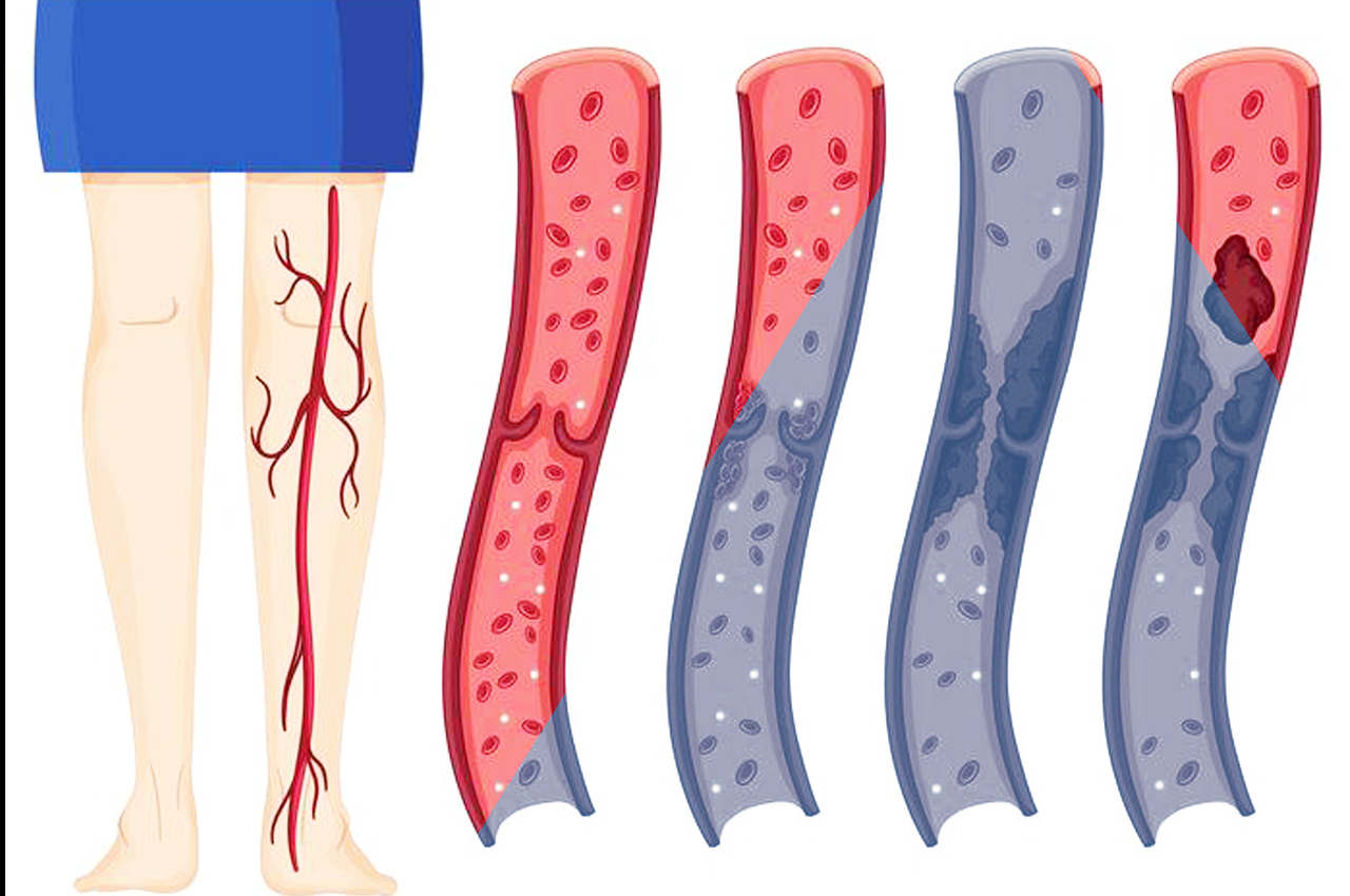 Trombosi venosa negli arti inferiori HTC Centro Medico Stradella PV