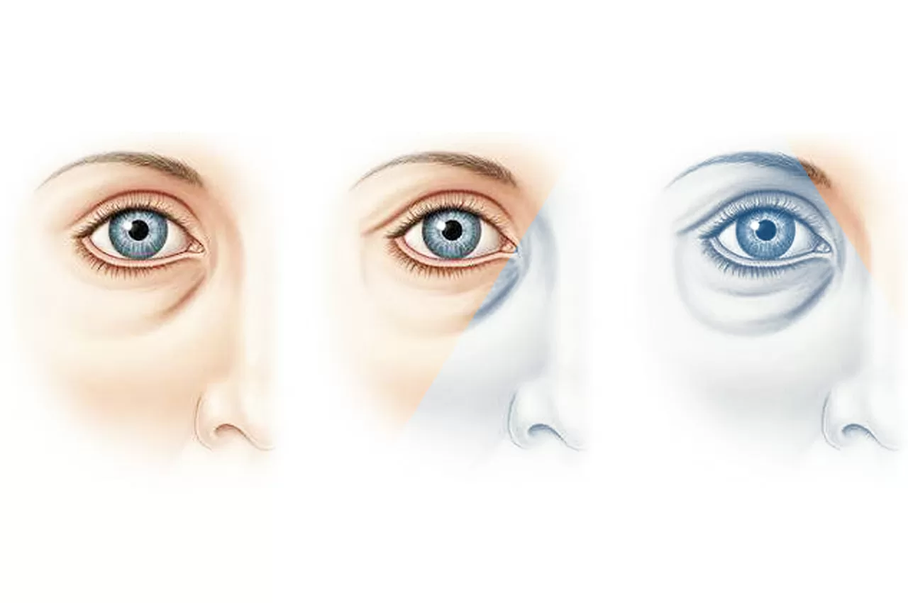 Oftalmopatia Tiroidea HTC Centro Medico Stradella PV