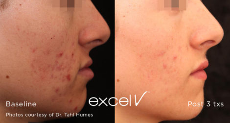 1064_Acne_2 - Trattamento Laser excel V Cutera - HTC Stradella