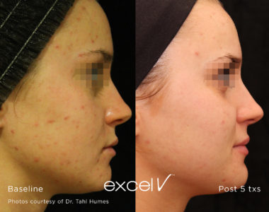 1064_Acne_3 - Trattamento Laser excel V Cutera - HTC Stradella