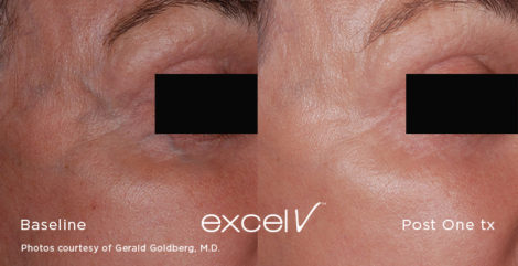1064_Periorbital Vein_3 - Trattamento Laser excel V Cutera - HTC Stradella
