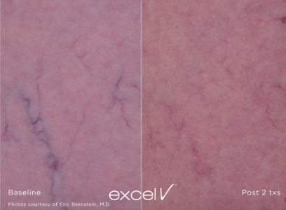 1064_Vascular_10 - Trattamento Laser excel V Cutera - HTC Stradella