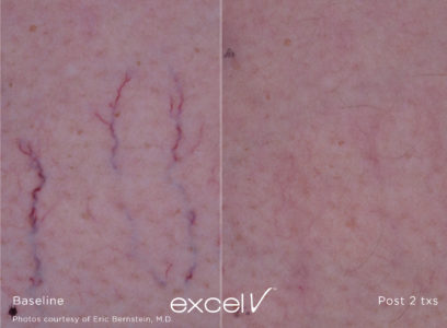 1064_Vascular_12 - Trattamento Laser excel V Cutera - HTC Stradella
