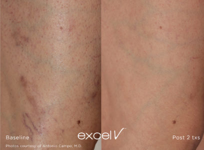 1064_Vascular_14 - Trattamento Laser excel V Cutera - HTC Stradella