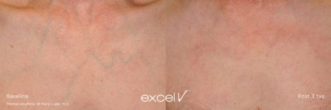 1064_Vascular_7 - Trattamento Laser excel V Cutera - HTC Stradella