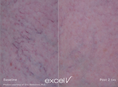 1064_Vascular_8 - Trattamento Laser excel V Cutera - HTC Stradella