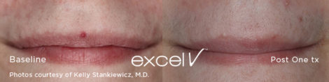 532_Angioma_2 - Trattamento Laser excel V Cutera - HTC Stradella