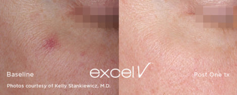 532_Angioma_3 - Trattamento Laser excel V Cutera - HTC Stradella