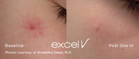 532_Angioma_5 - Trattamento Laser excel V Cutera - HTC Stradella