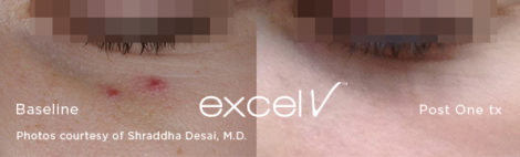 532_Angioma_6 - Trattamento Laser excel V Cutera - HTC Stradella