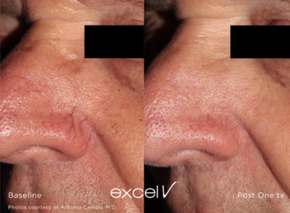 532_Angioma_9 - Trattamento Laser excel V Cutera - HTC Stradella