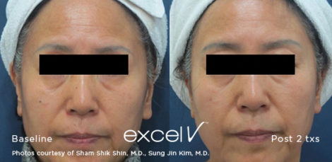 532_Pigment-Shin_2 - Trattamento Laser excel V Cutera - HTC Stradella