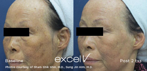 532_Pigment-Shin_3 - Trattamento Laser excel V Cutera - HTC Stradella