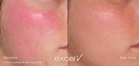 532_Rosecea_3 - Trattamento Laser excel V Cutera - HTC Stradella