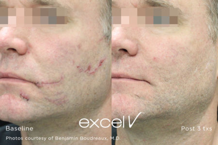 532_Scar_1 - Trattamento Laser excel V Cutera - HTC Stradella
