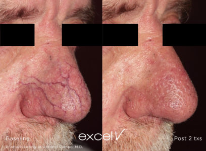 532_Telangiectasia_10 - Trattamento Laser excel V Cutera - HTC Stradella