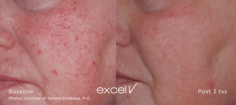532_Telangiectasia_3 - Trattamento Laser excel V Cutera - HTC Stradella