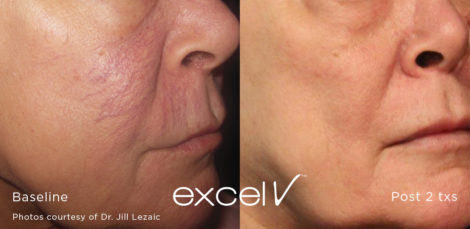 532_Telangiectasia_6 - Trattamento Laser excel V Cutera - HTC Stradella