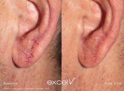 532_Telangiectasia_7 - Trattamento Laser excel V Cutera - HTC Stradella