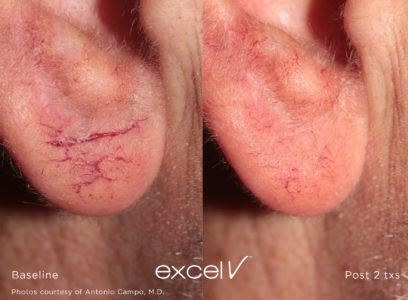 532_Telangiectasia_8 - Trattamento Laser excel V Cutera - HTC Stradella
