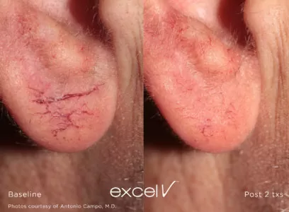 532_Telangiectasia_8 - Trattamento Laser excel V Cutera - HTC Stradella