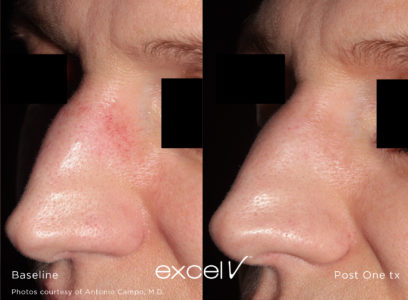 532_Telangiectasia_9 - Trattamento Laser excel V Cutera - HTC Stradella