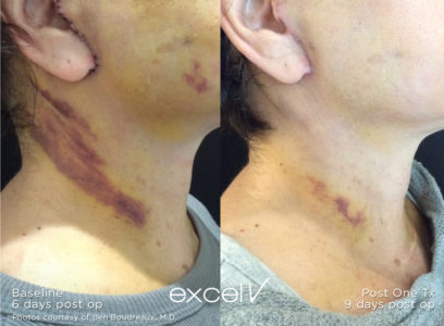 532_bruising_2 - Trattamento Laser excel V Cutera - HTC Stradella