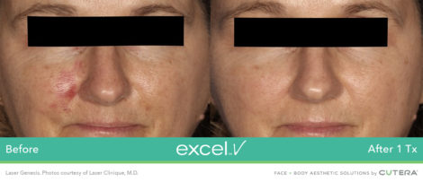 Laser Excel V Cutera - HTC Centro Medico Stradella PV