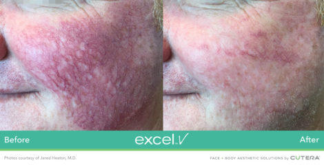 Laser Excel V Cutera - HTC Centro Medico Stradella PV