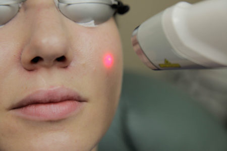 Ringiovanimento cutaneo1 - Trattamento Laser excel V Cutera - HTC Stradella
