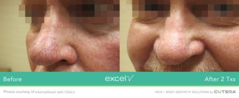 Laser Excel V Cutera - HTC Centro Medico Stradella PV