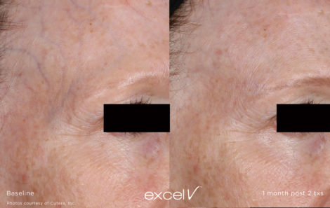 Laser Excel V Cutera - HTC Centro Medico Stradella PV