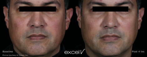 Laser Excel V Cutera - HTC Centro Medico Stradella PV