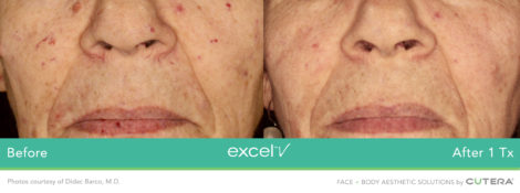 Laser Excel V Cutera - HTC Centro Medico Stradella PV
