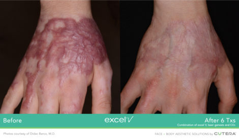 Laser Excel V Cutera - HTC Centro Medico Stradella PV