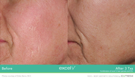 Laser Excel V Cutera - HTC Centro Medico Stradella PV