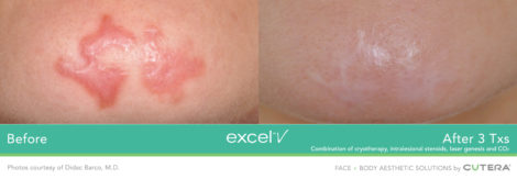 Laser Excel V Cutera - HTC Centro Medico Stradella PV