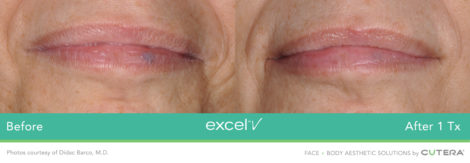 Laser Excel V Cutera - HTC Centro Medico Stradella PV