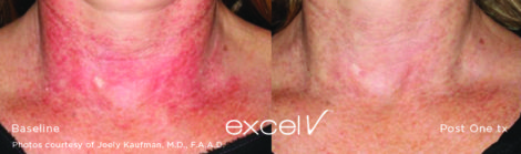 Trattamento Laser Poichelodermia - HTC Centro Medico Stradella PV