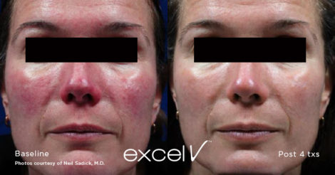 Trattamento Laser Rosacea - HTC Centro Medico Stradella PV