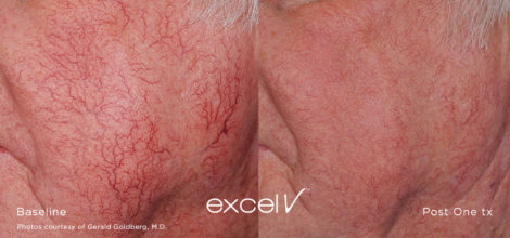 Trattamento laser capillari viso e gambe - HTC Centro Medico Stradella PV