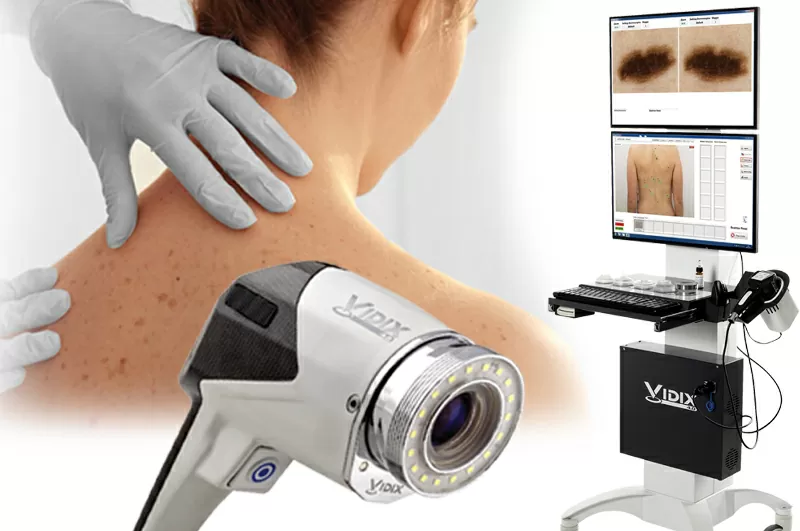 Mappatura nei con videodermatoscopio