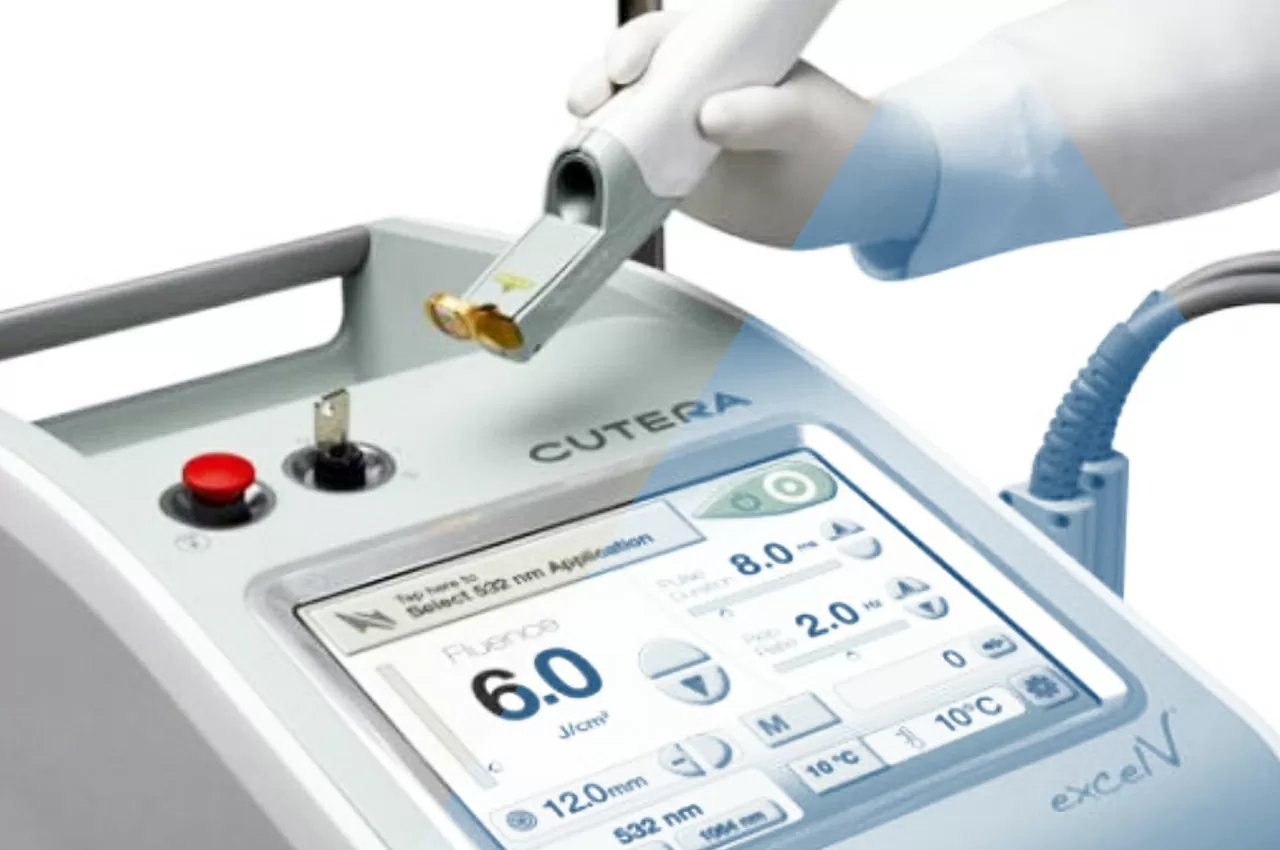 Laser Excel V per inestetismi vascolari della pelle