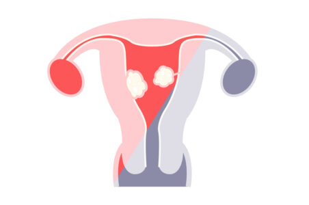 Fibroma uterino - HTC Centro Medico Stradella Pavia