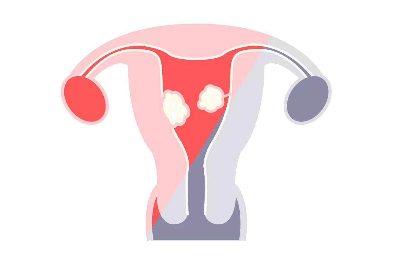 Fibroma uterino - HTC Centro Medico Stradella Pavia