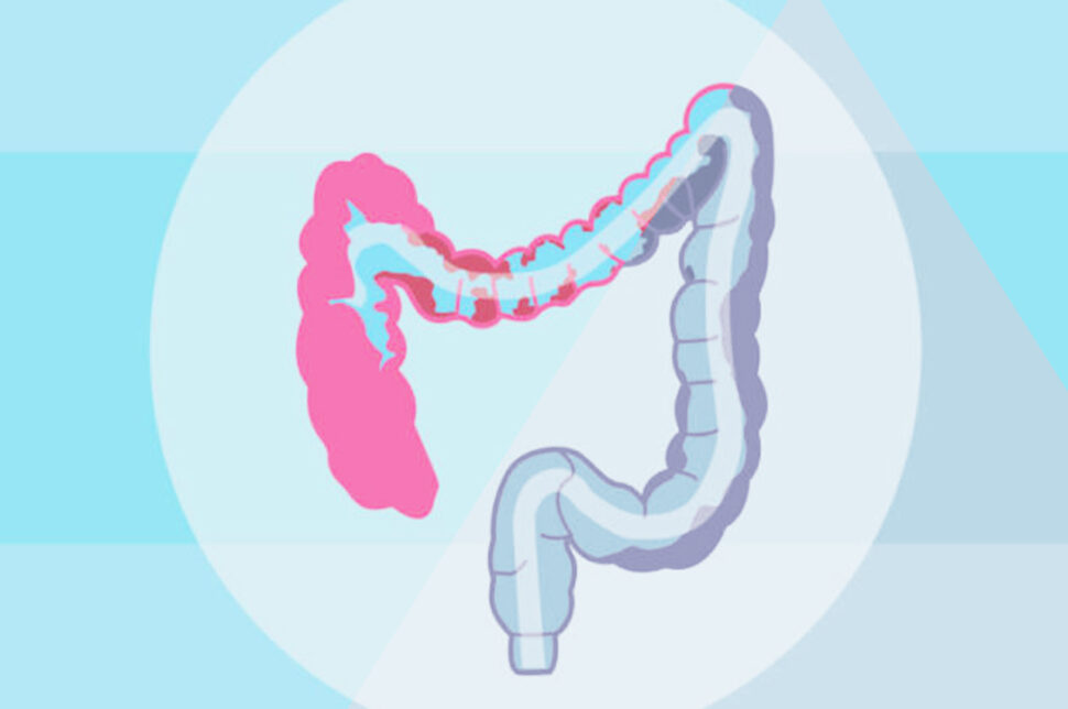 Colon-Wash, pulizia del colon in HTC - Centro Medico Stradella Pavia