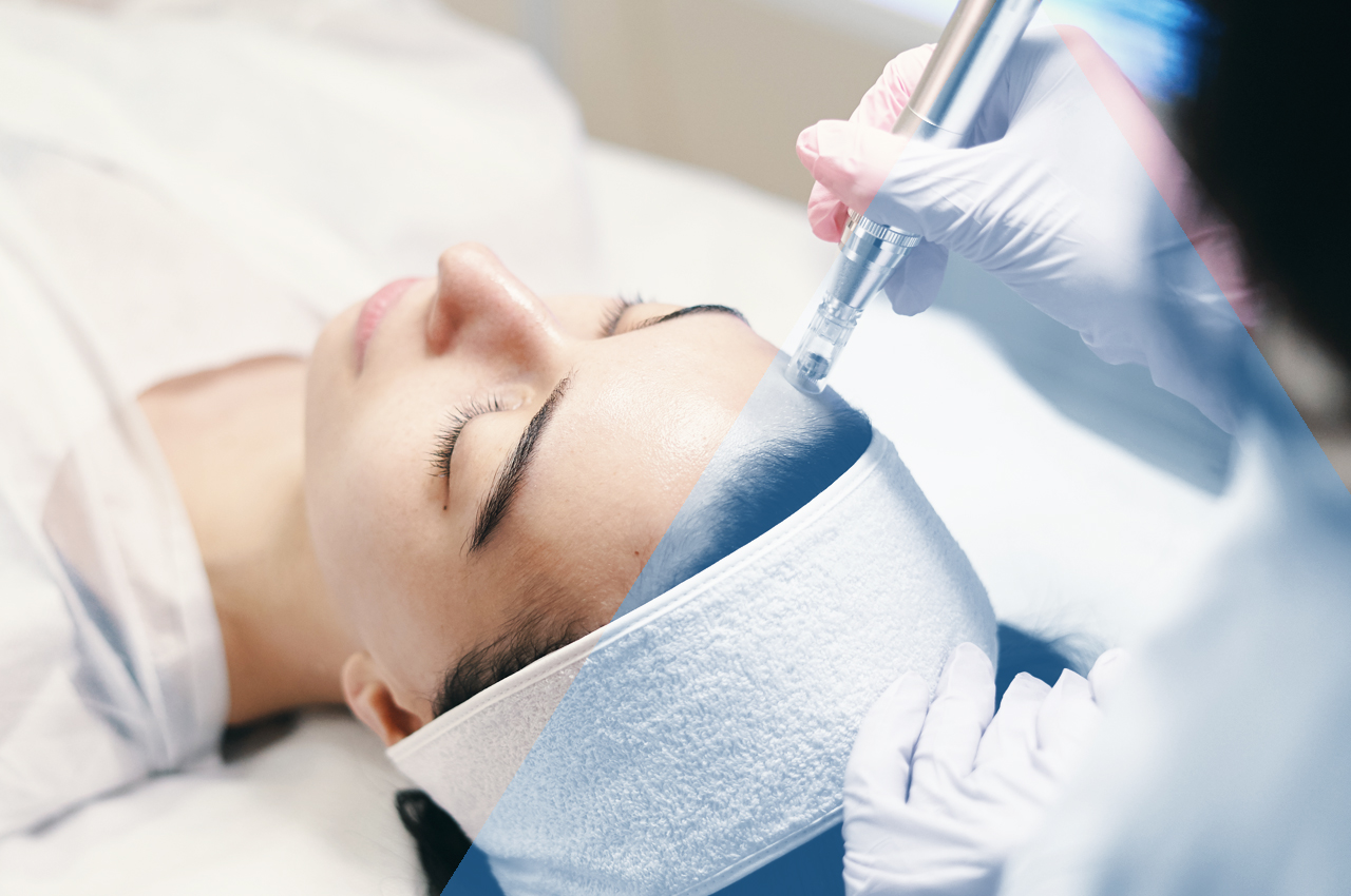 Microneedling - Medicina Estetica